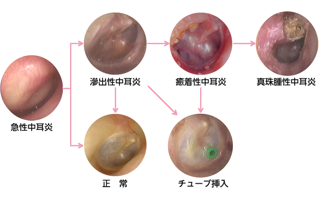 耳かき し 過ぎ