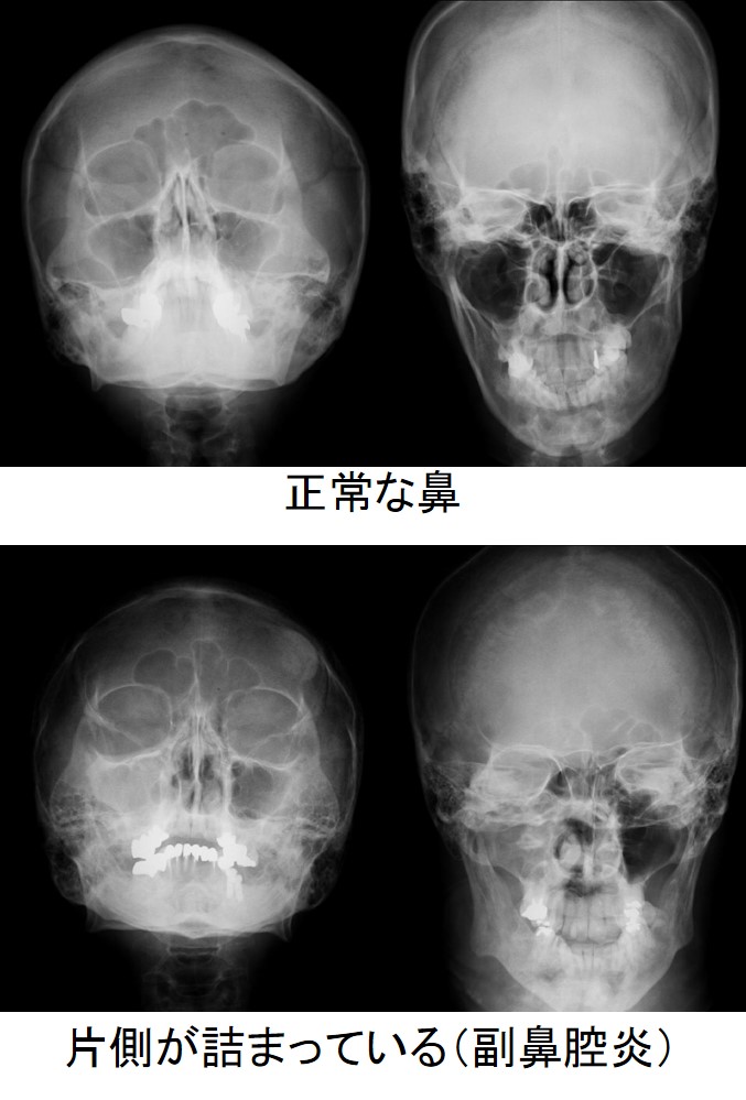 副 鼻腔 炎 痰