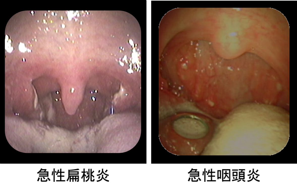 喉の病気 扁桃炎の治療は 横浜市都筑区のおおた耳鼻咽喉科へ