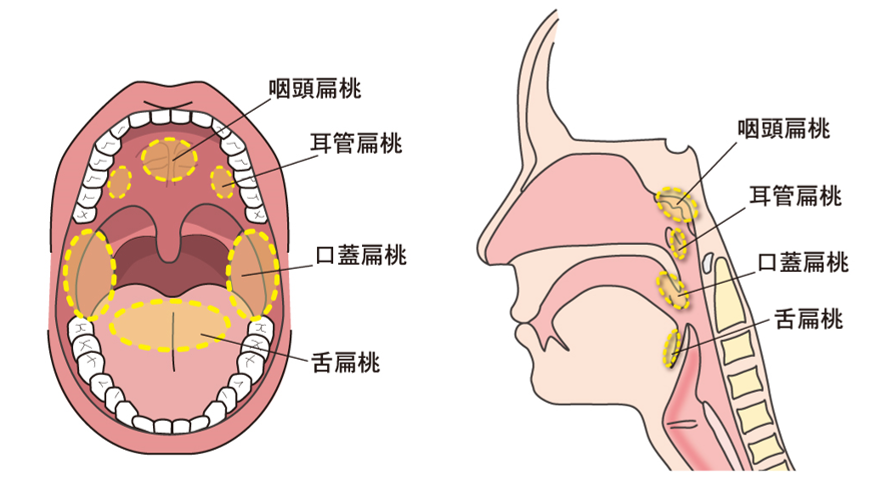 扁桃 腺 手術 日帰り