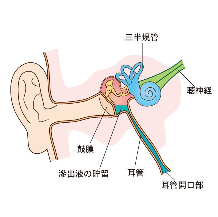 耳 管 開放 症 治し 方
