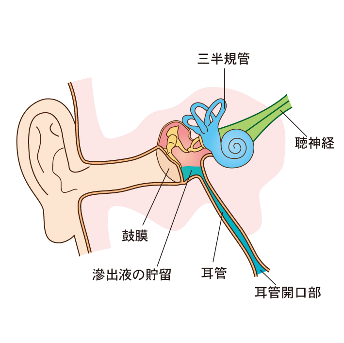 滲出性中耳炎の治療 鼓膜切開術 鼓膜チューブ留置術 横浜市都筑区 おおた耳鼻咽喉科